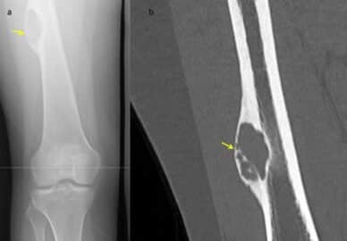 Kemik Kisti Hastaligi